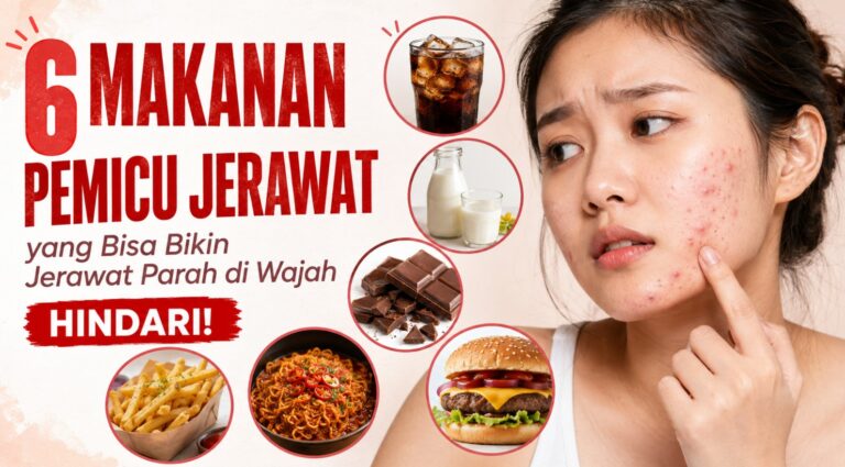Hindari! 6 Jenis Makanan yang Bisa Memicu Jerawat Parah di Wajah